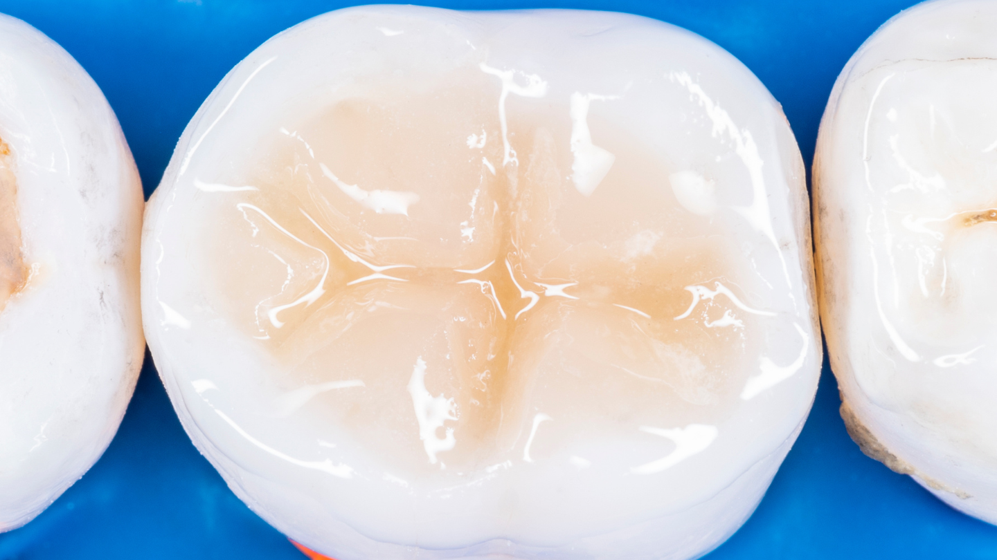 Dental Fillings Explained: How Tooth-Coloured Fillings Restore Your Smile